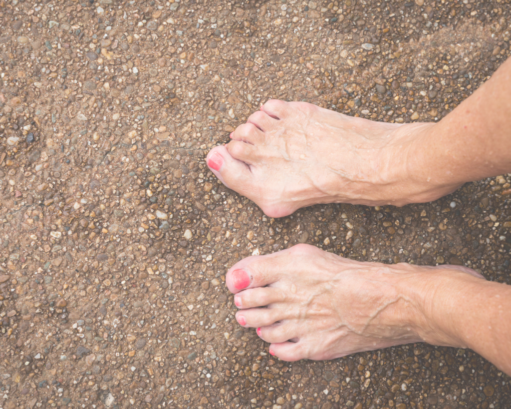 Hammertoe condition treated by podiatrists