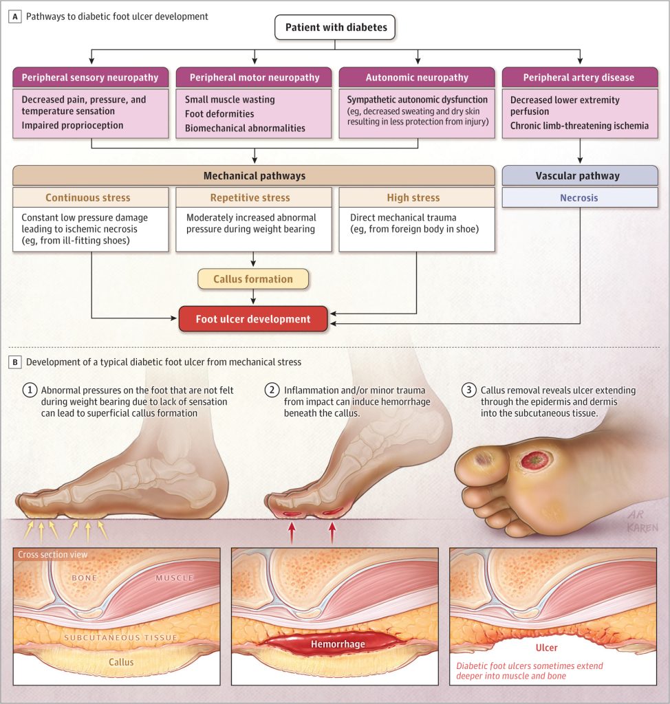 Pathways to Diabetic Foot Ulceration (Mechanical and Ischemic Factors)